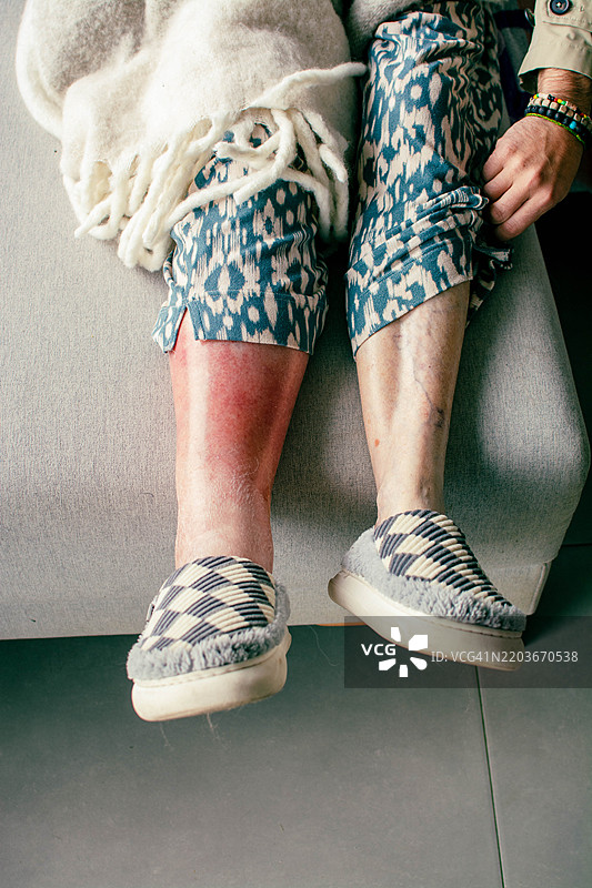 坐在沙发上的老年女性展示她疼痛的红色腿部图片素材