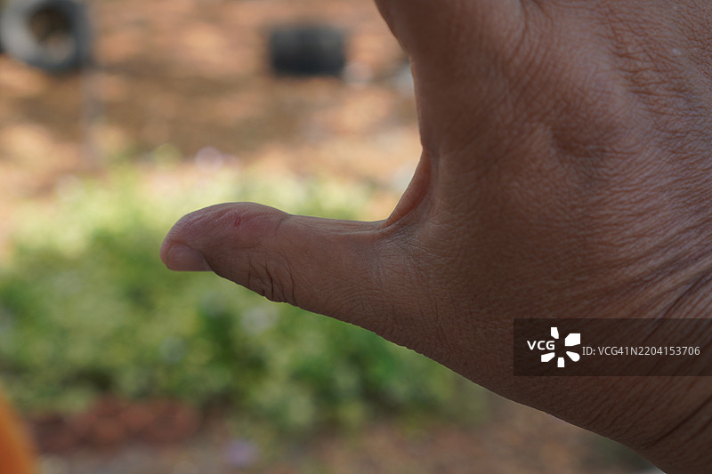 拇指溃疡图片素材