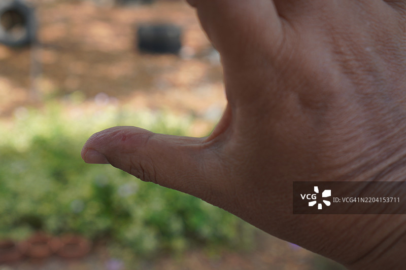 拇指溃疡图片素材