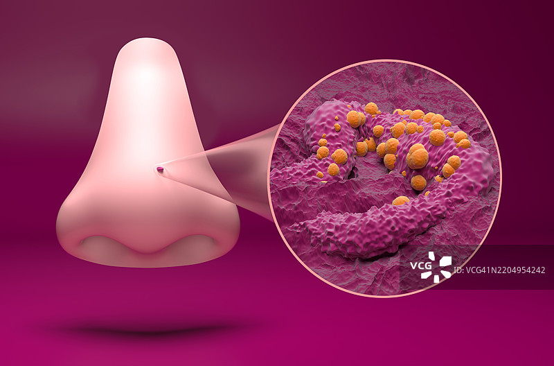基底细胞癌插图图片素材