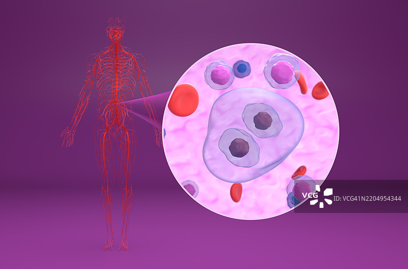 霍奇金淋巴瘤插图图片素材