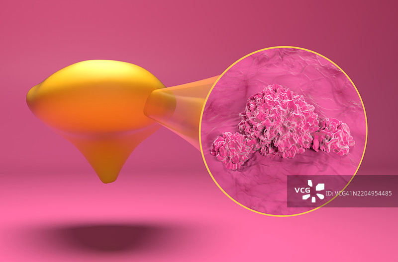 膀胱癌插图图片素材