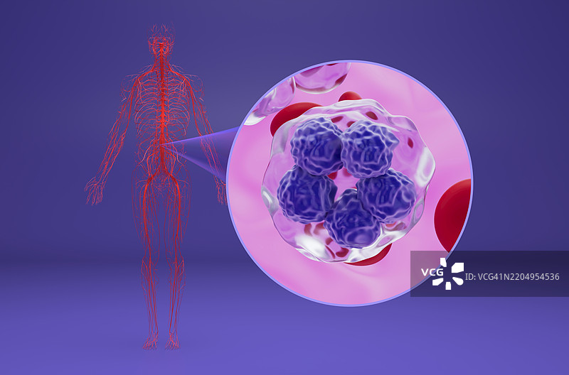 T细胞淋巴瘤插图图片素材