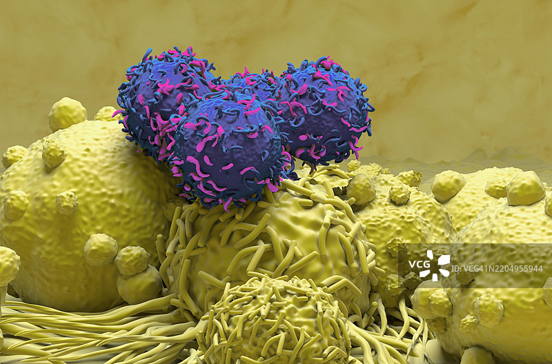 肾癌的CAR-T细胞疗法插图图片素材