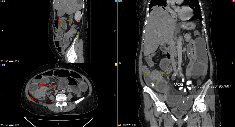 结肠癌，CT扫描图片素材