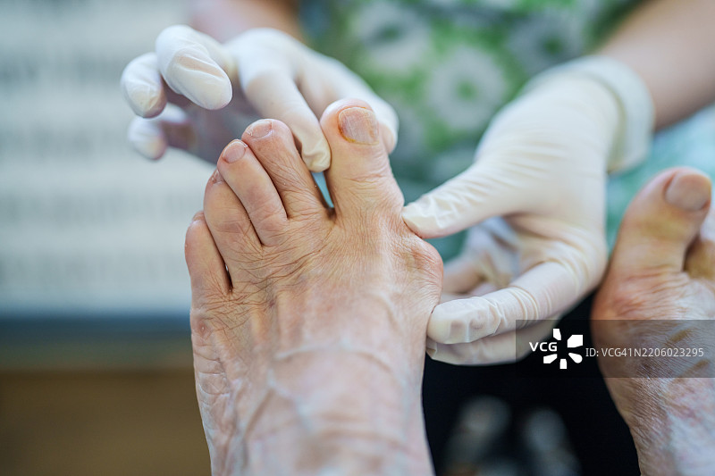 医生检查老年患者的脚部拇外翻（大脚趾外翻）图片素材