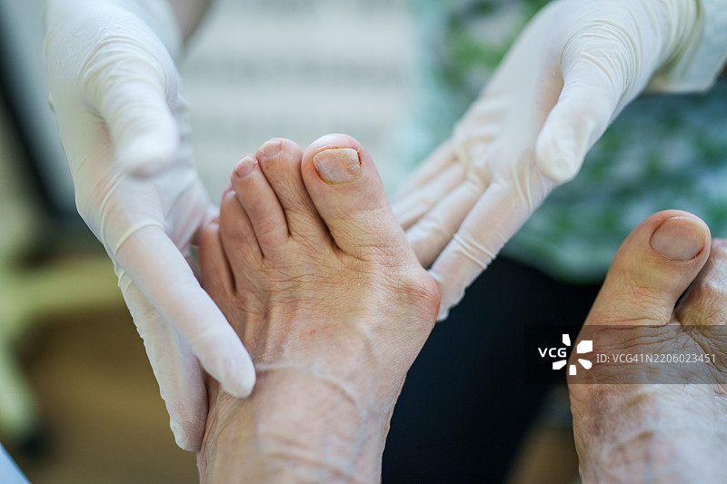 医生检查老年患者的脚部拇外翻（大脚趾外翻）图片素材