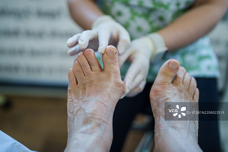医生检查老年患者的脚部拇外翻（大脚趾外翻）图片素材