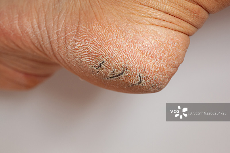 脚跟干裂皮肤的特写，临床状况视觉图图片素材
