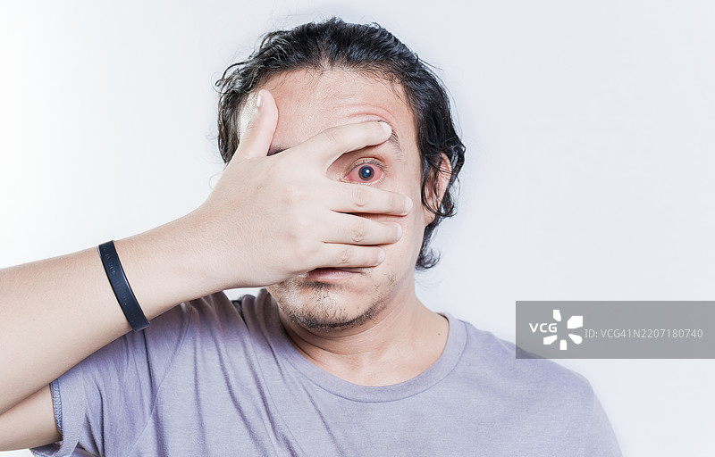 年轻男子因结膜炎而被隔离。眼睛刺激的人盯着镜头。因眼部感染而被隔离的男子。图片素材