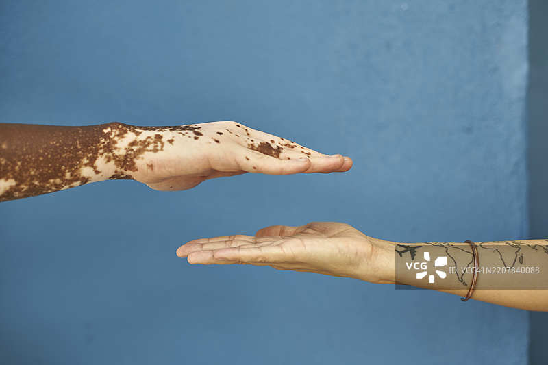 一名患有白癜风的男性手与一名白人女性的手在蓝色墙壁前。图片素材