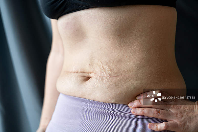 柔软腹部的特写，带有褶皱和妊娠纹图片素材