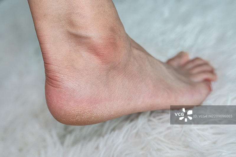 剪裁的镜头显示一个人脚部的干裂脚跟问题。图片素材