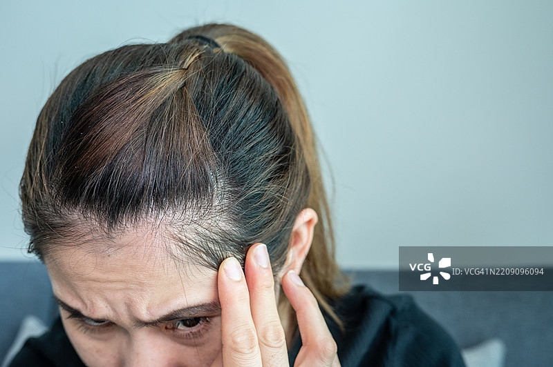 亚洲女性担心自己额头的头发稀疏，她有脱发问题。图片素材