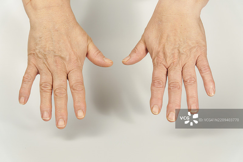 老年女性手部特写，显示指关节炎症状图片素材