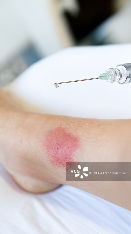 对昆虫叮咬的过敏反应 对黄蜂和蚊子叮咬的过敏图片素材