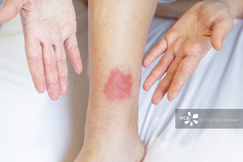 对昆虫叮咬的过敏反应 对黄蜂和蚊子叮咬的过敏图片素材