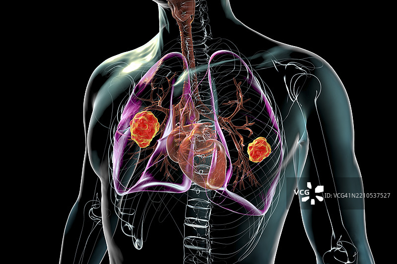 肺部毛霉病插图图片素材
