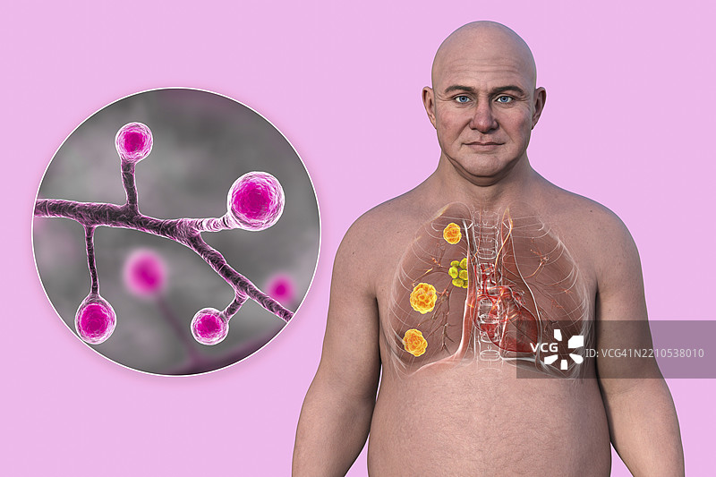 受爆发霉菌病影响的肺部插图图片素材