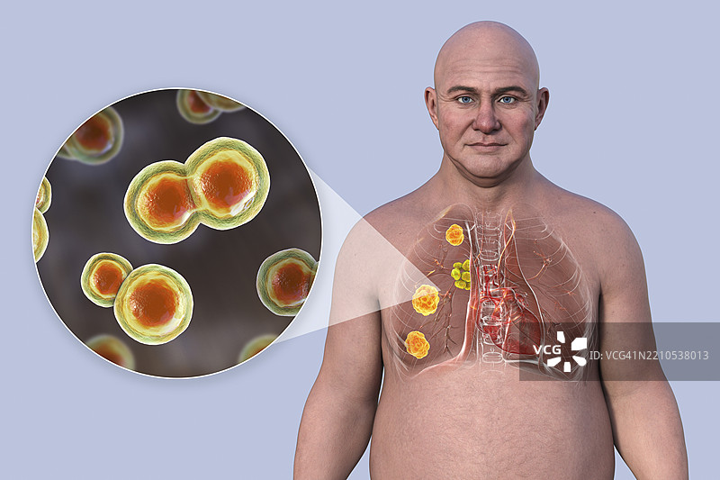 受爆发霉菌病影响的肺部插图图片素材
