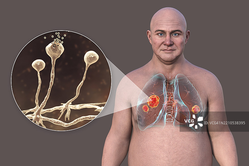 肺部毛霉病插图图片素材