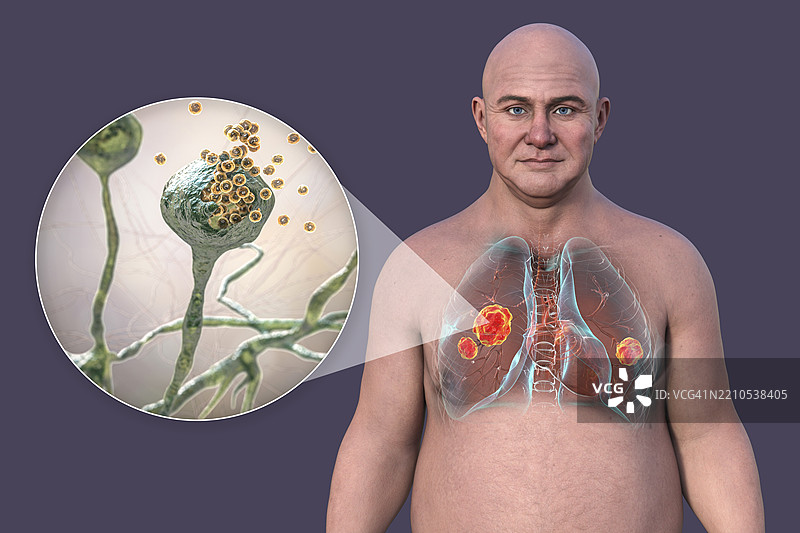 肺部毛霉病插图图片素材