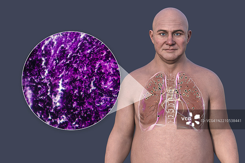 肺硅肺病及光学显微镜图解图片素材