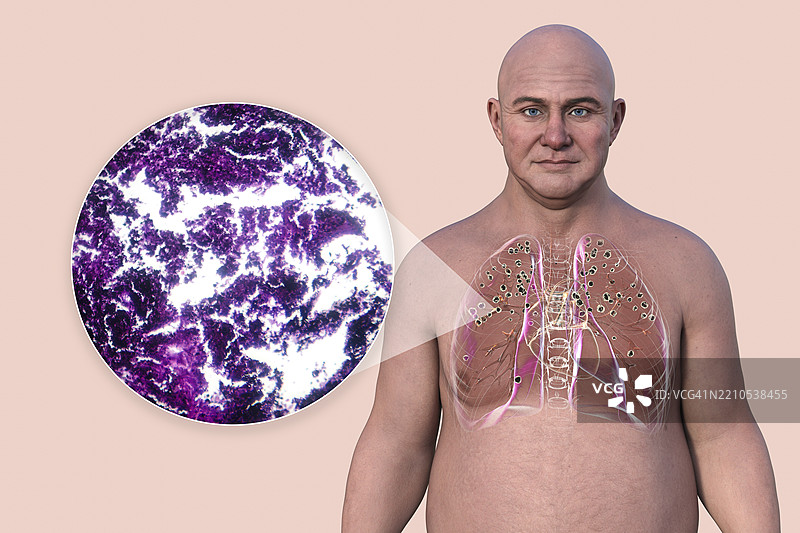 肺硅肺病和光学显微镜图，插图图片素材