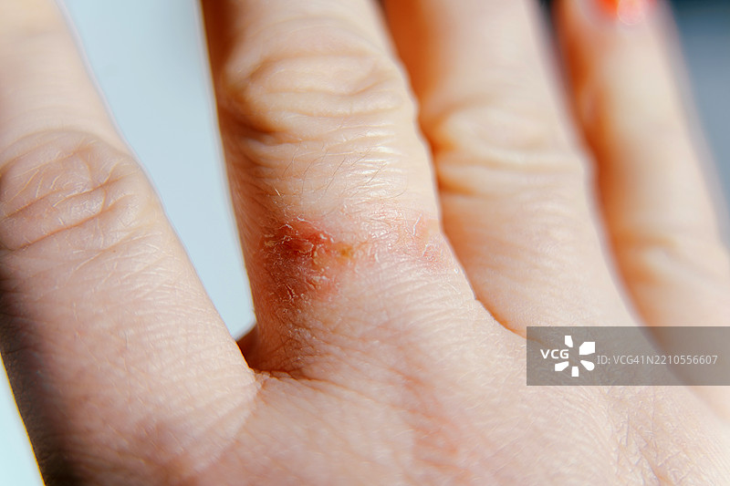 手指因佩戴戒指而出现的刺激。皮肤病、湿疹、过敏反应的迹象。特写，微距照片图片素材