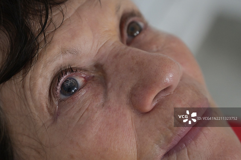 白内障手术后的眼睛特写图片素材