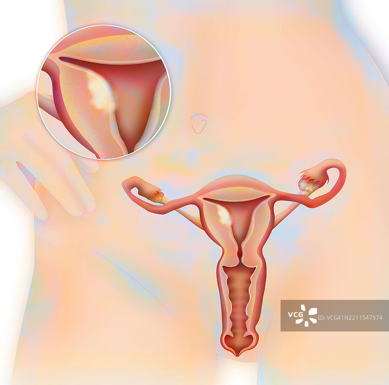 子宫内膜癌，图示图片素材