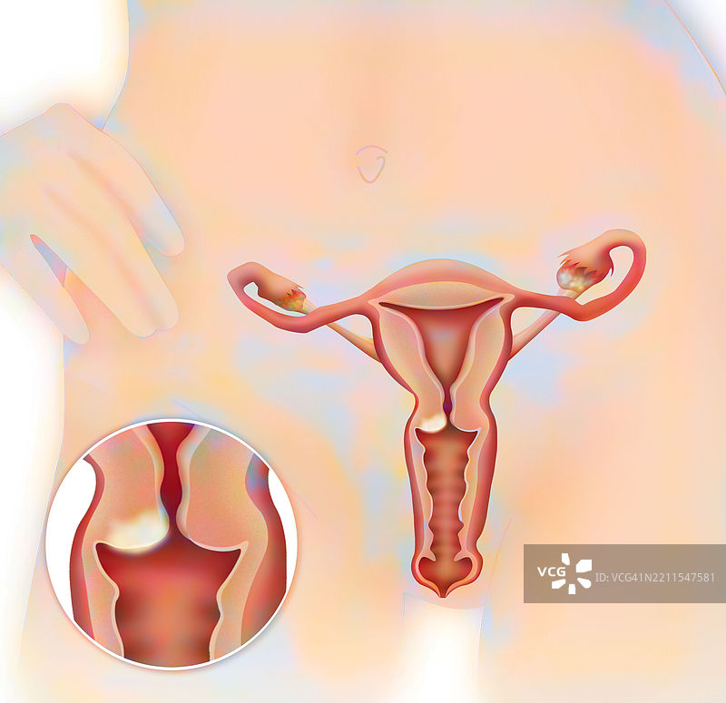 宫颈癌，插图图片素材