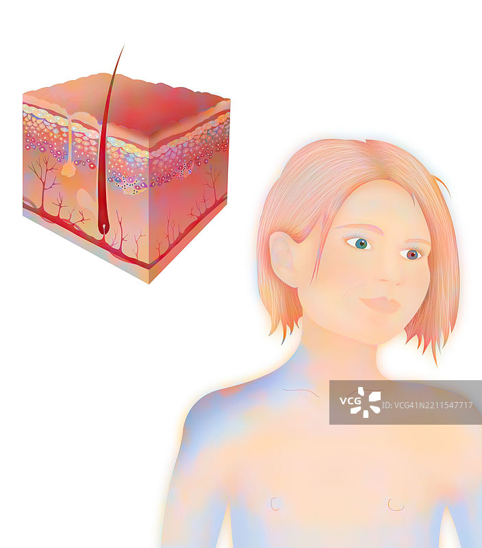 晒伤，绘画图片素材