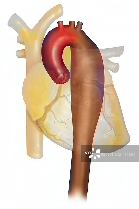 胸主动脉瘤图片素材