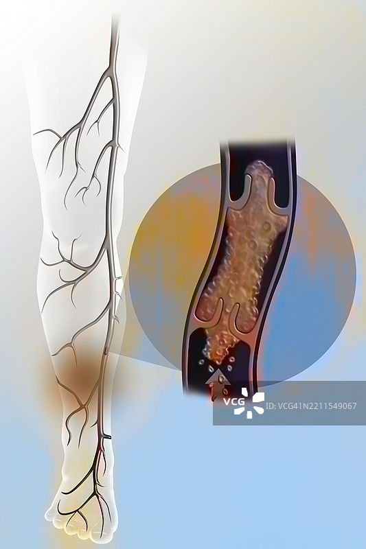 下肢静脉炎图片素材