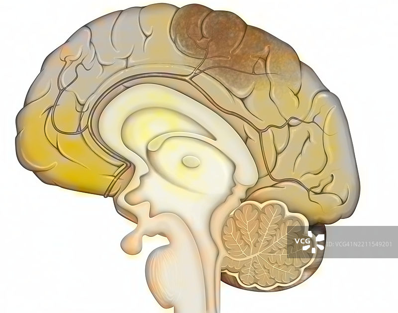 脑出血图片素材