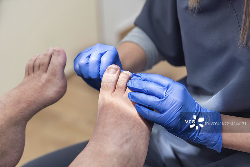 穿着蓝色手套的足病医生在足病治疗过程中检查患者的脚，提供专业的足部和指甲护理。图片素材