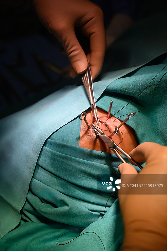 Surgical procedure showcasing precise medical techniques in an operating room setting图片素材