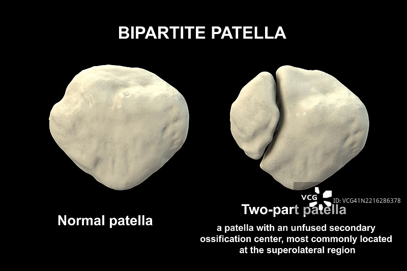 双瓣髌骨插图图片素材