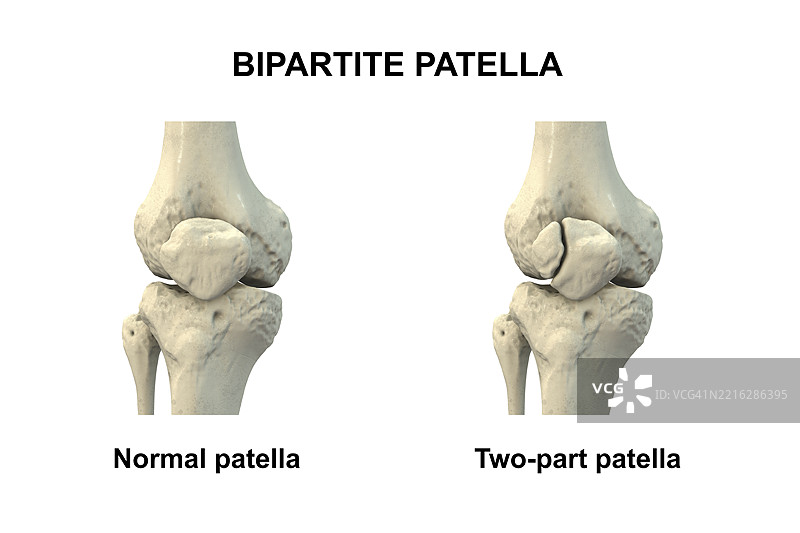 双瓣髌骨插图图片素材