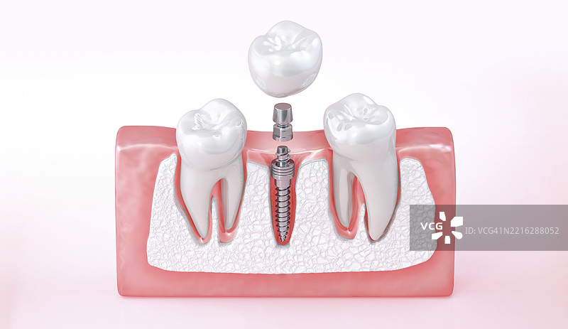 牙齿植入物插图图片素材