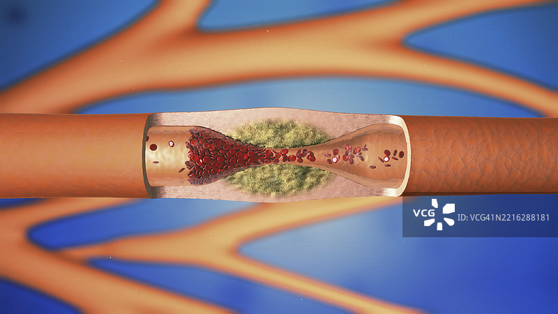 狭窄动脉插图图片素材