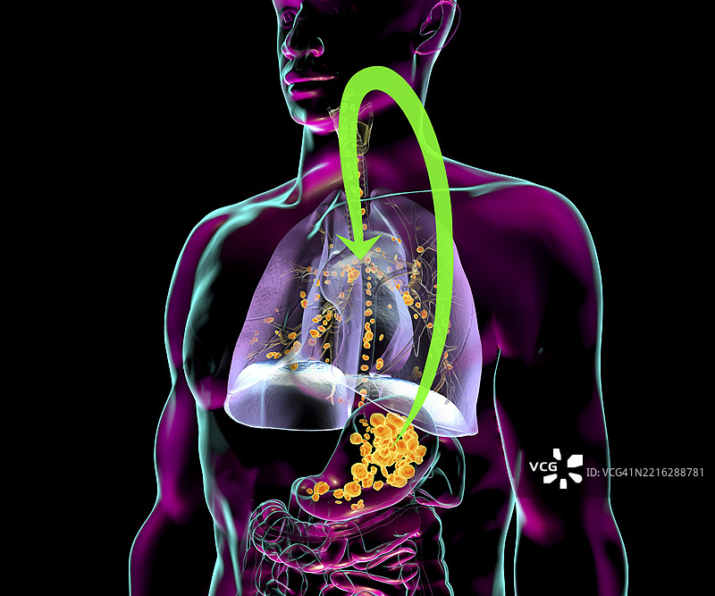 吸入性肺炎插图图片素材