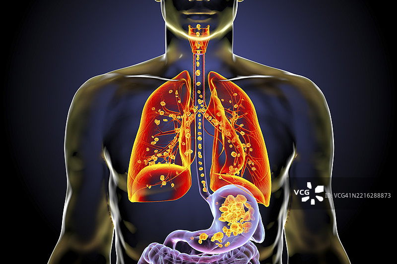 吸入性肺炎插图图片素材