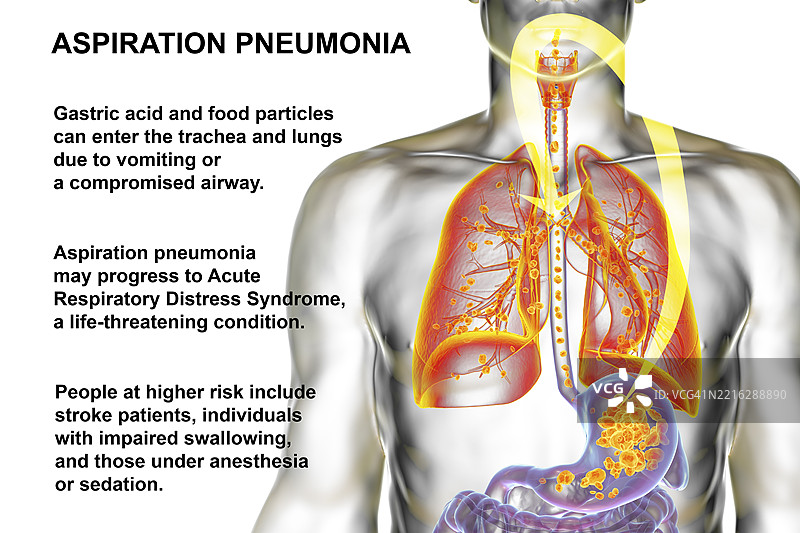 吸入性肺炎插图图片素材