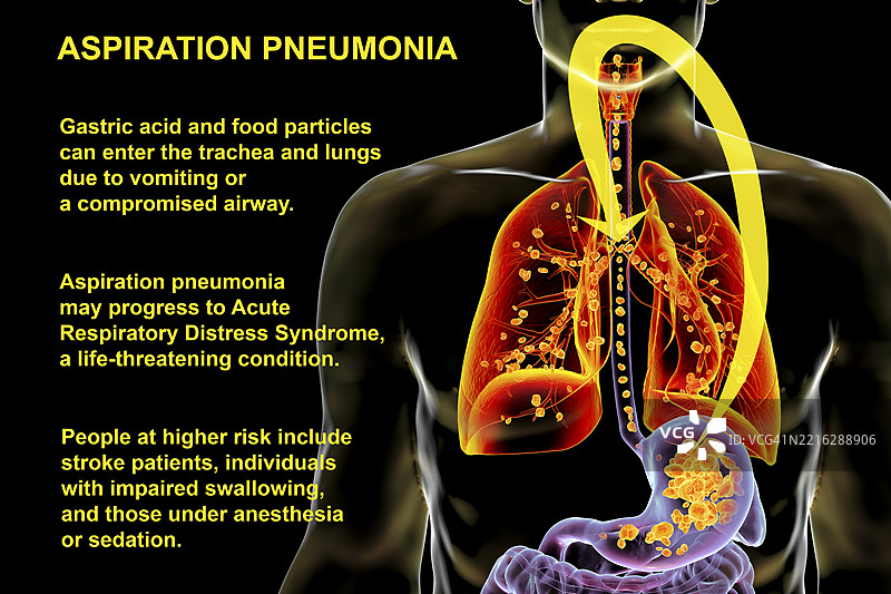 吸入性肺炎插图图片素材