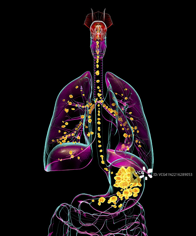 吸入性肺炎插图图片素材