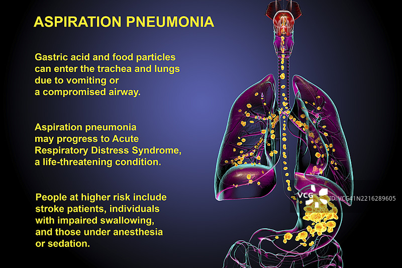 吸入性肺炎插图图片素材