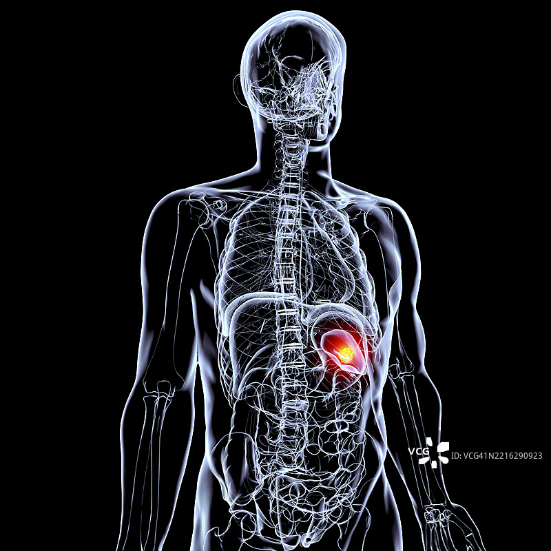 脾脏癌，插图图片素材
