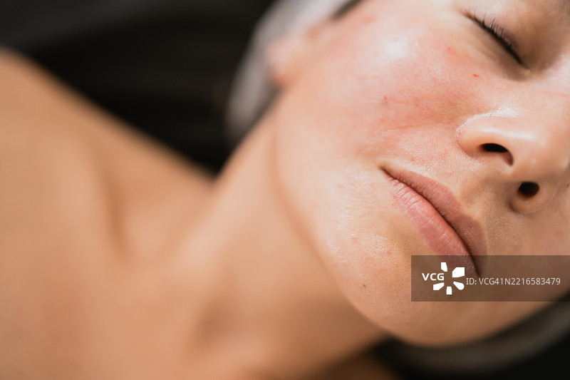 年轻女性闭眼放松，面部有红斑和痤疮图片素材